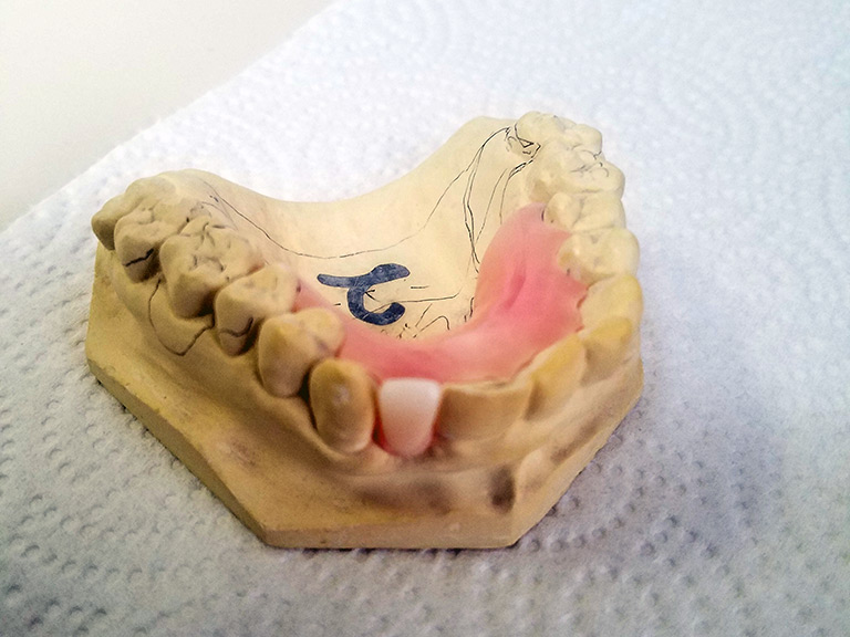 Dentures